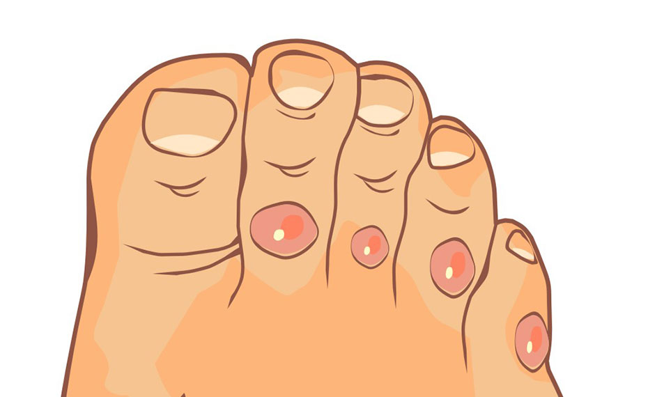 Corn Removal Via Laser Treatment Tired Sole