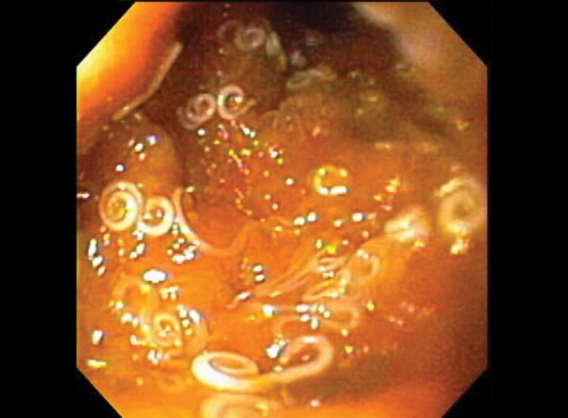Lower Gastrointestinal Endoscopy Series, Part 1 Overview