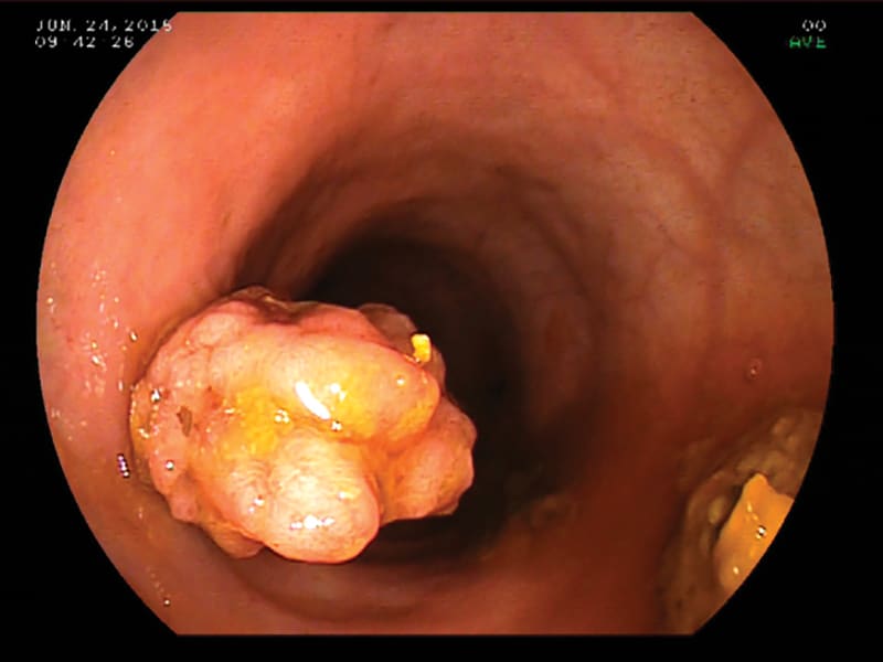 Lower Gastrointestinal Endoscopy Series, Part 1 Overview