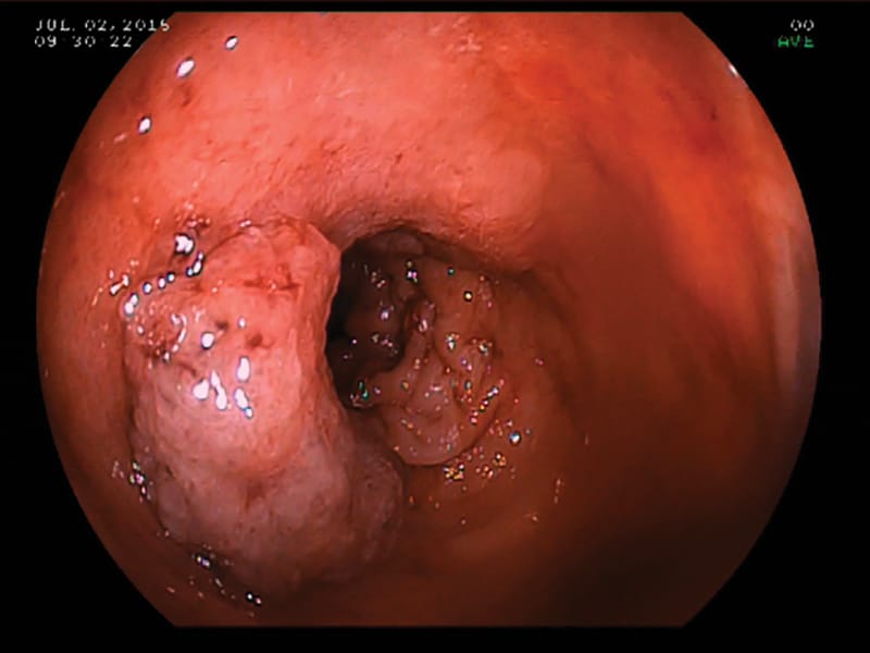 Lower Gastrointestinal Endoscopy Series, Part 1 Overview