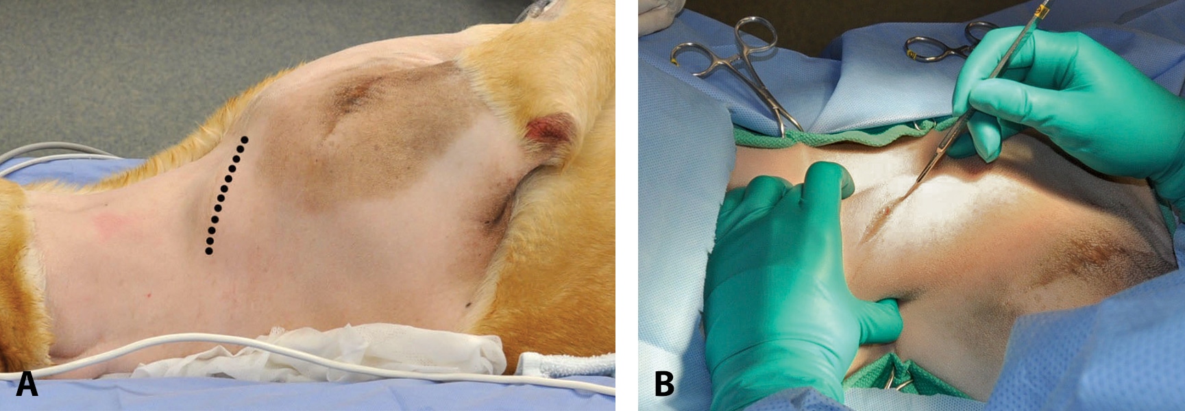 Lymphadenectomy Overview of Surgical Anatomy & Removal of