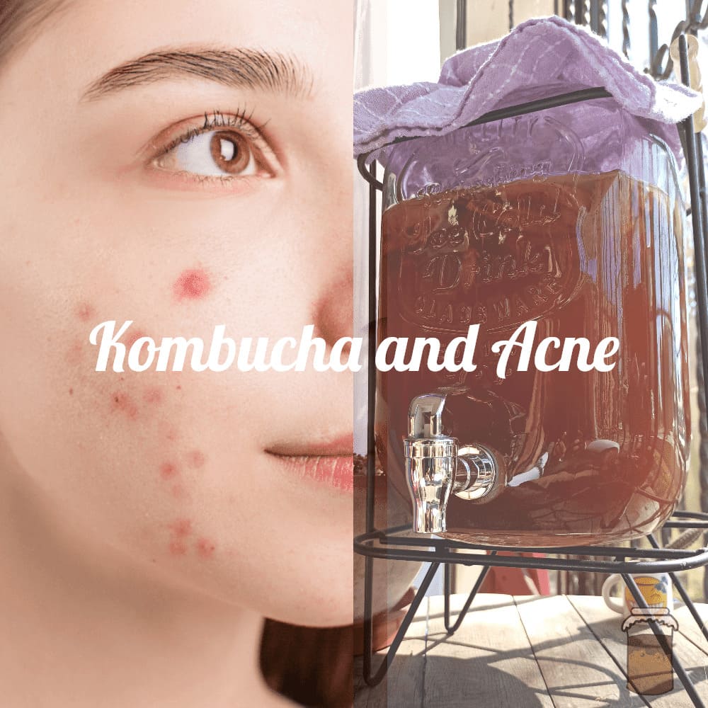 Kombucha Helps With Acne (Myth or Real?) Todo Kombucha