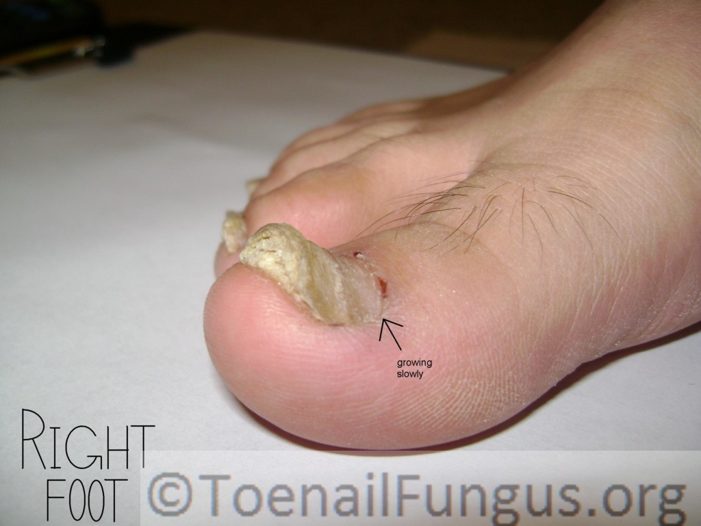 Improving Fungus Feet using Vinegar and Tee Tree Oil Toenail Fungus