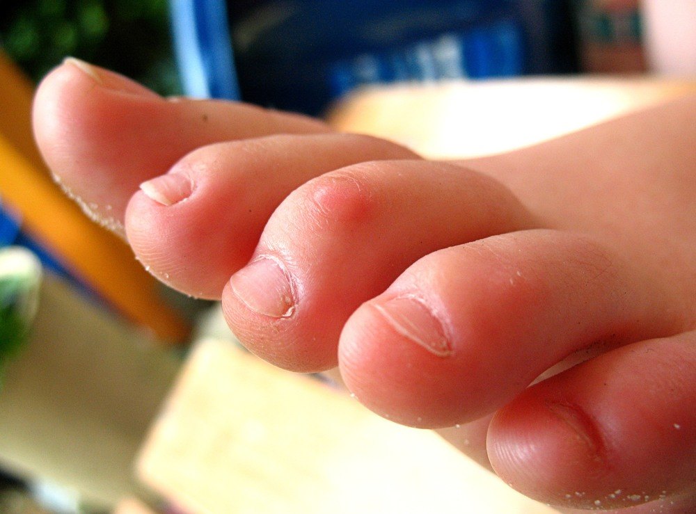 What Causes Corns on Your Toes Toenail Fungus Tips