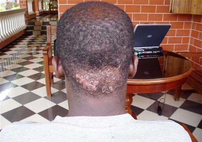 Les boutons derrière la nuque pourquoi et comment s’en débarrasser