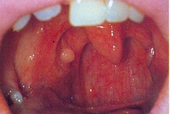 Tonsil Cyst Symptoms, causes, treatment, pictures and more