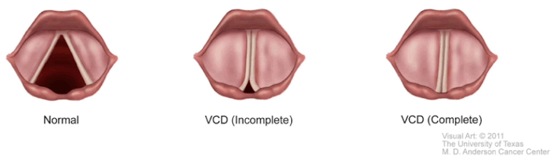 Vocal Cord Dysfunction (VCD) Severe Asthma Toolkit