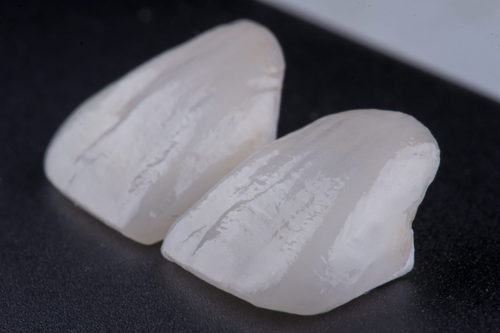 Veneers Durability Do They Fall Off Easily?