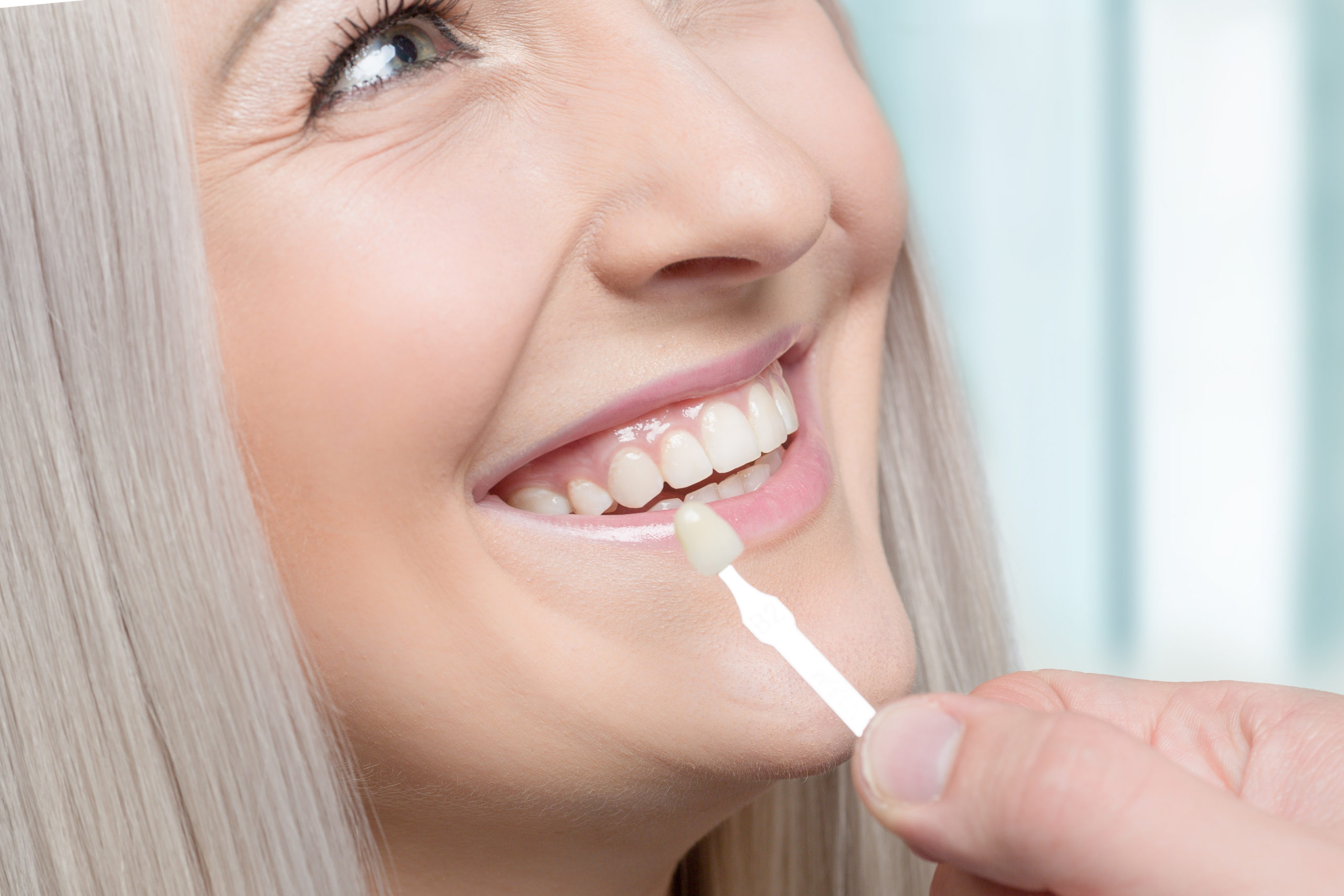 Veneer Lifespan When Should You Replace Your Dental Veneers?
