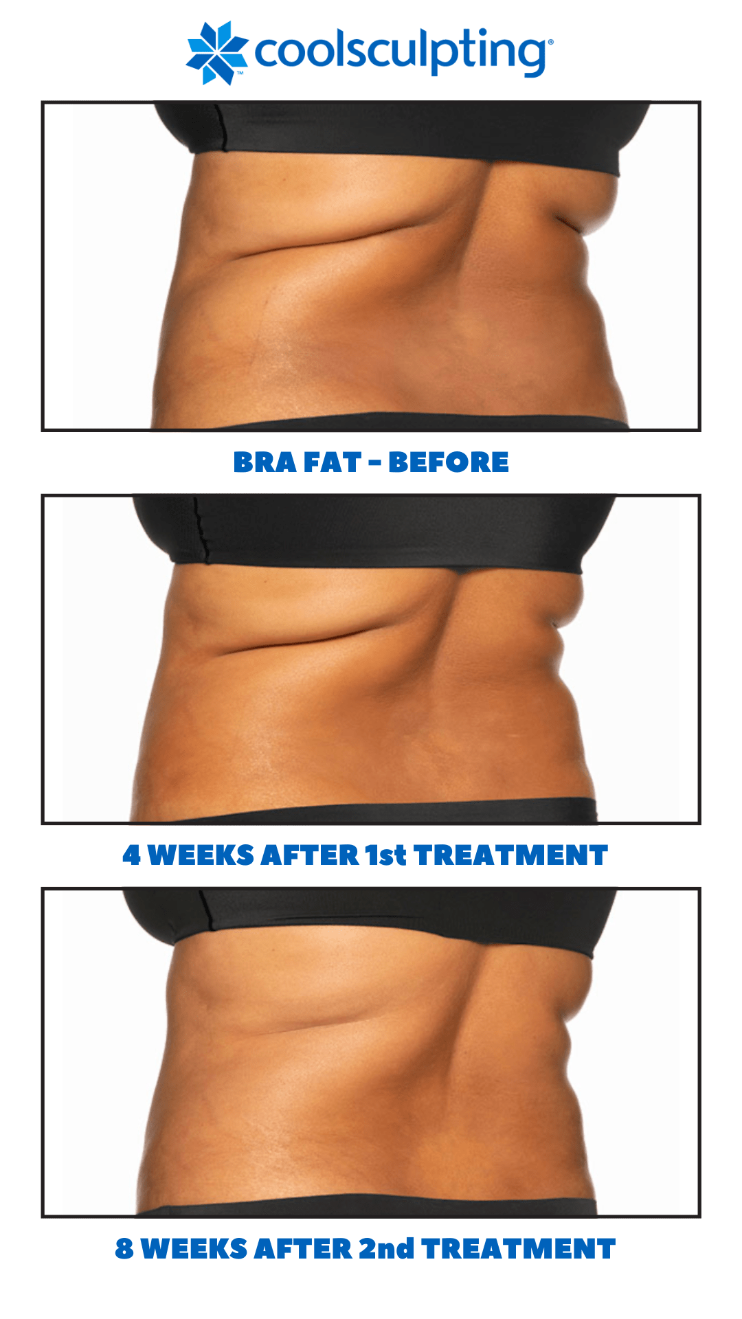 Coolsculpting Toossi Medical