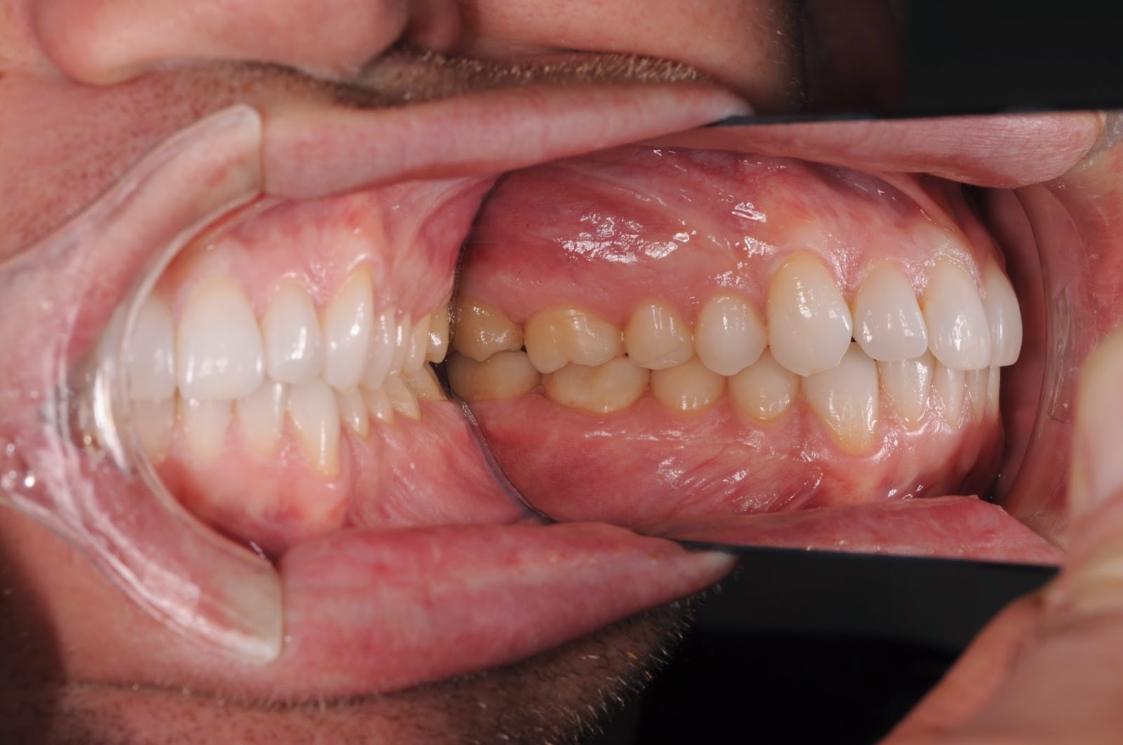 Q What is the best intraoral mirror? Toothgood