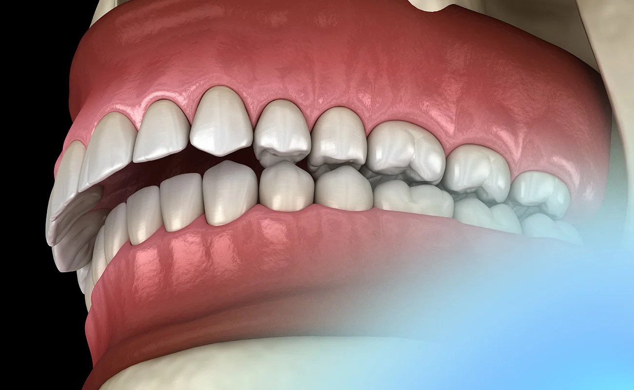 Overbite Face Shape We Answer Frequently Asked Questions