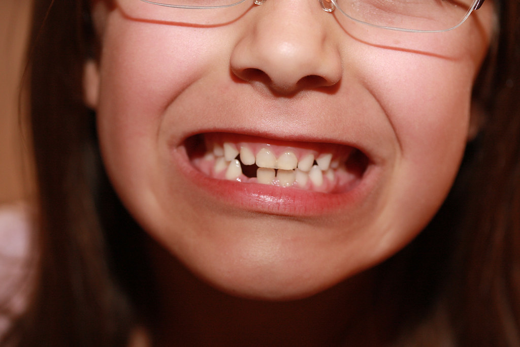 How Can Missing Teeth Affect Your Oral Health? Tooth Implant