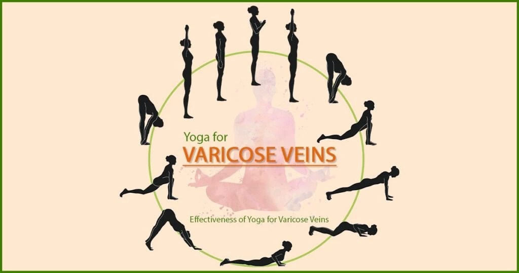 Does yoga improve varicose veins Top Laser Clinic