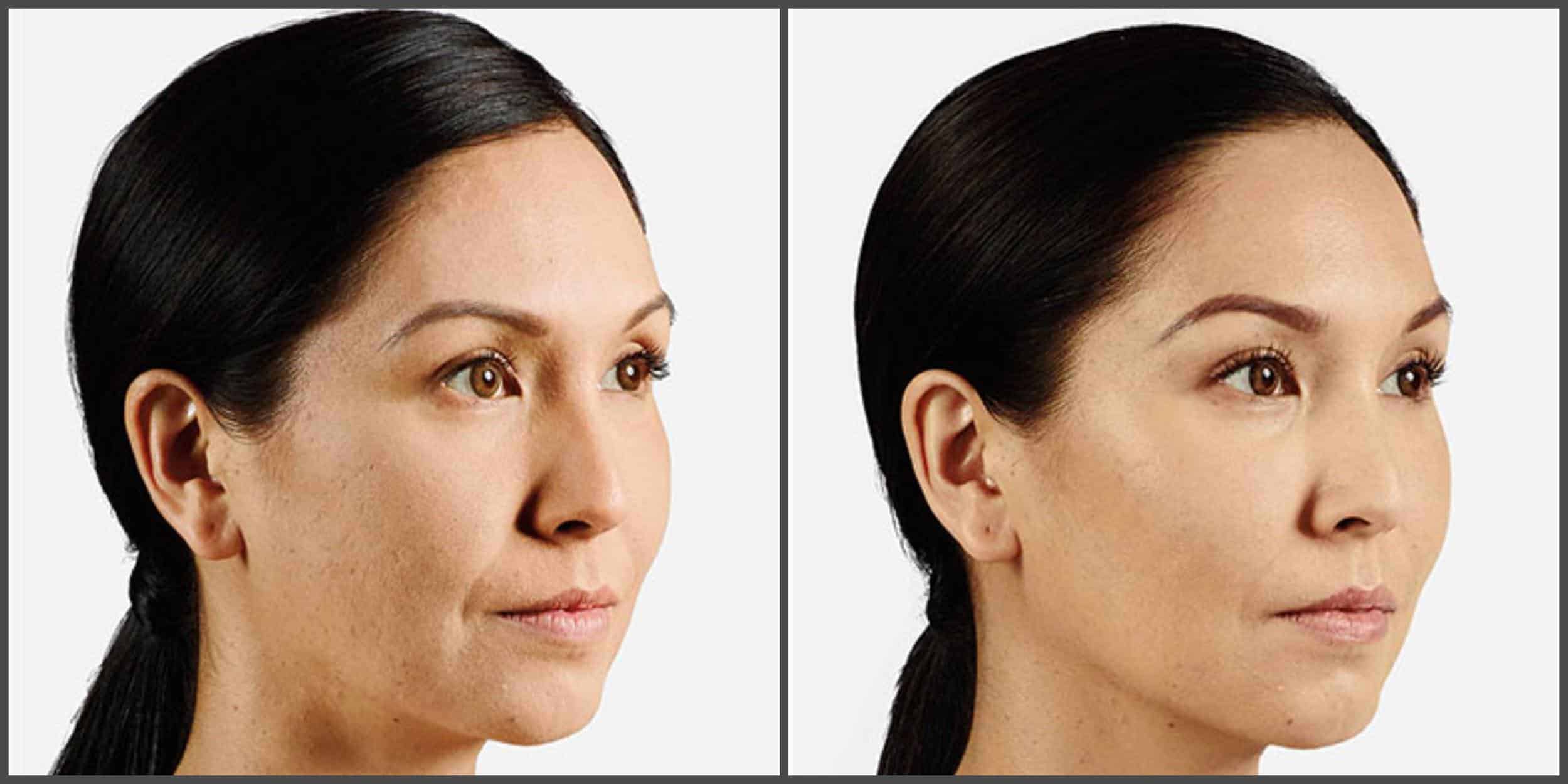 Juvederm Cost, Side Effects, Risks and How Long Does It Last?