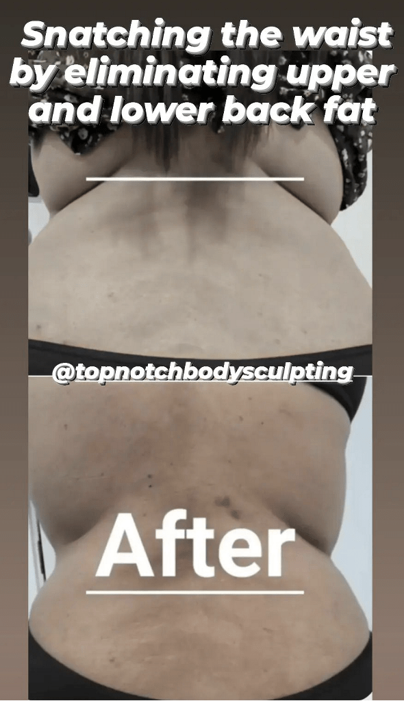 Before + After Top Notch Body Sculpting