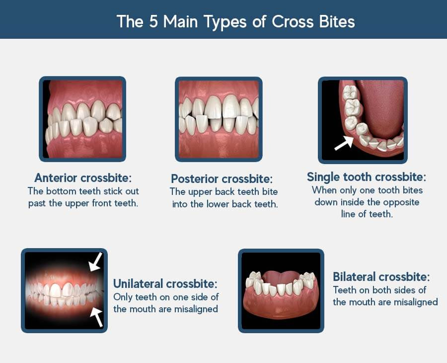 Mastering CrossBite Solutions For 2023 Unlock Your Best Smile Top