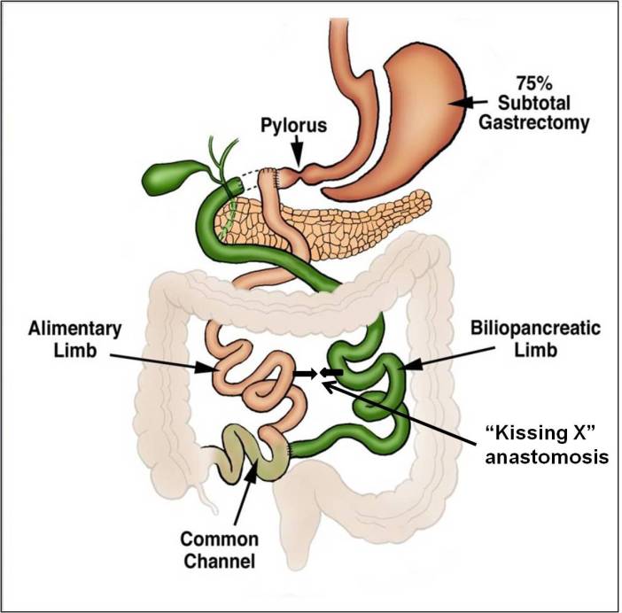 Top Weight Loss Surgery Houston Tx Saving Lives Every Day
