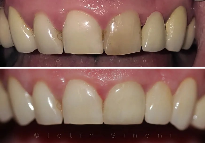 Dental crowns in Tirana What is the best material for dental crown?