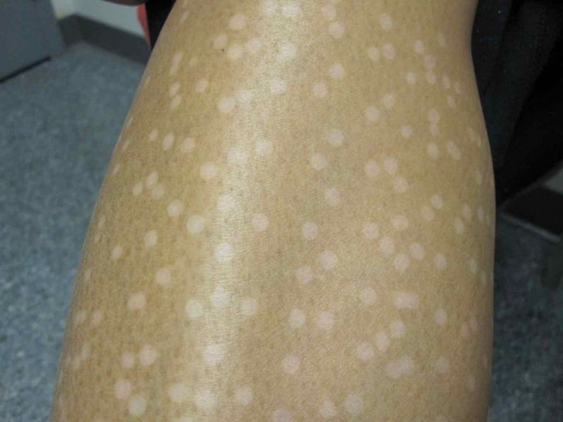 Laser burns by inexperienced practitioners be careful out there