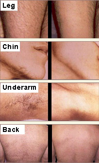 Temporary irritation, leading to slight blistering or crusting of the skin; Laser Hair Removal Toronto, Ontario | Best Hair Removal