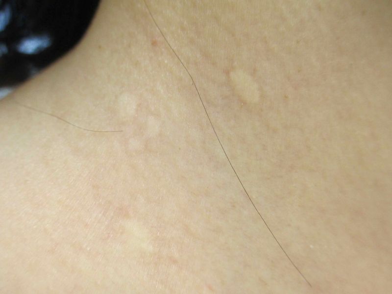 Over the counter skin tag removers cause burns and scars Toronto