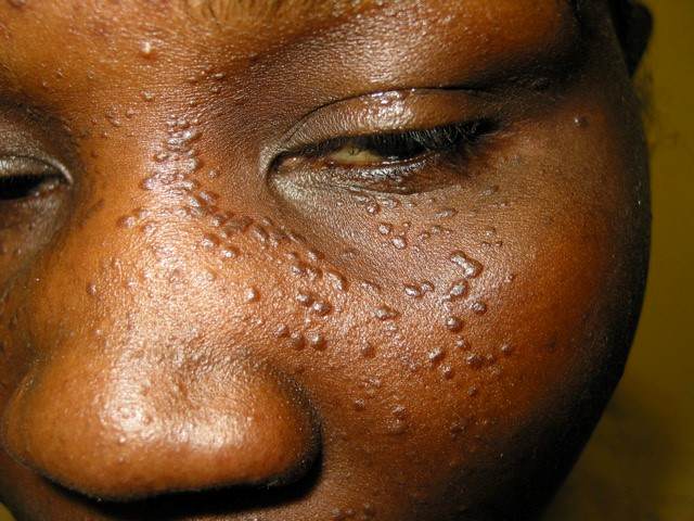Syringomas Symptoms, Causes, & Treatment Toronto