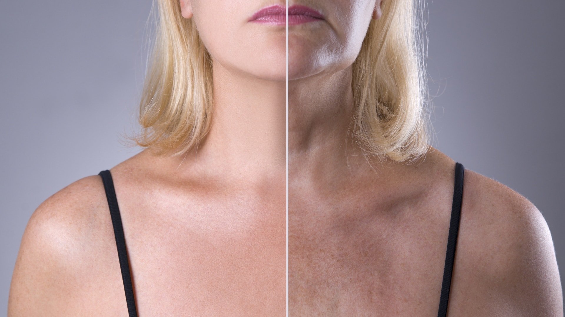 Melasma Toronto Dermatology Centre