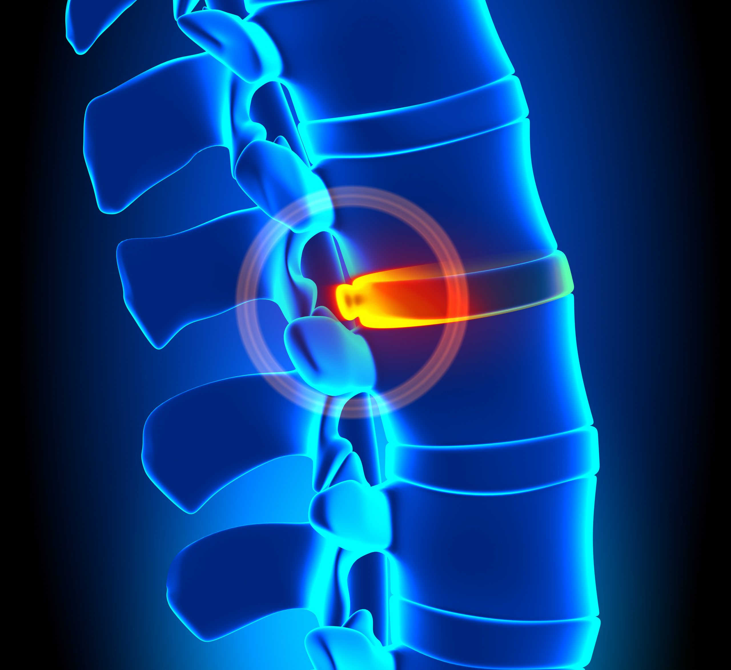 Bulging Discs Total Spine and Orthopedics