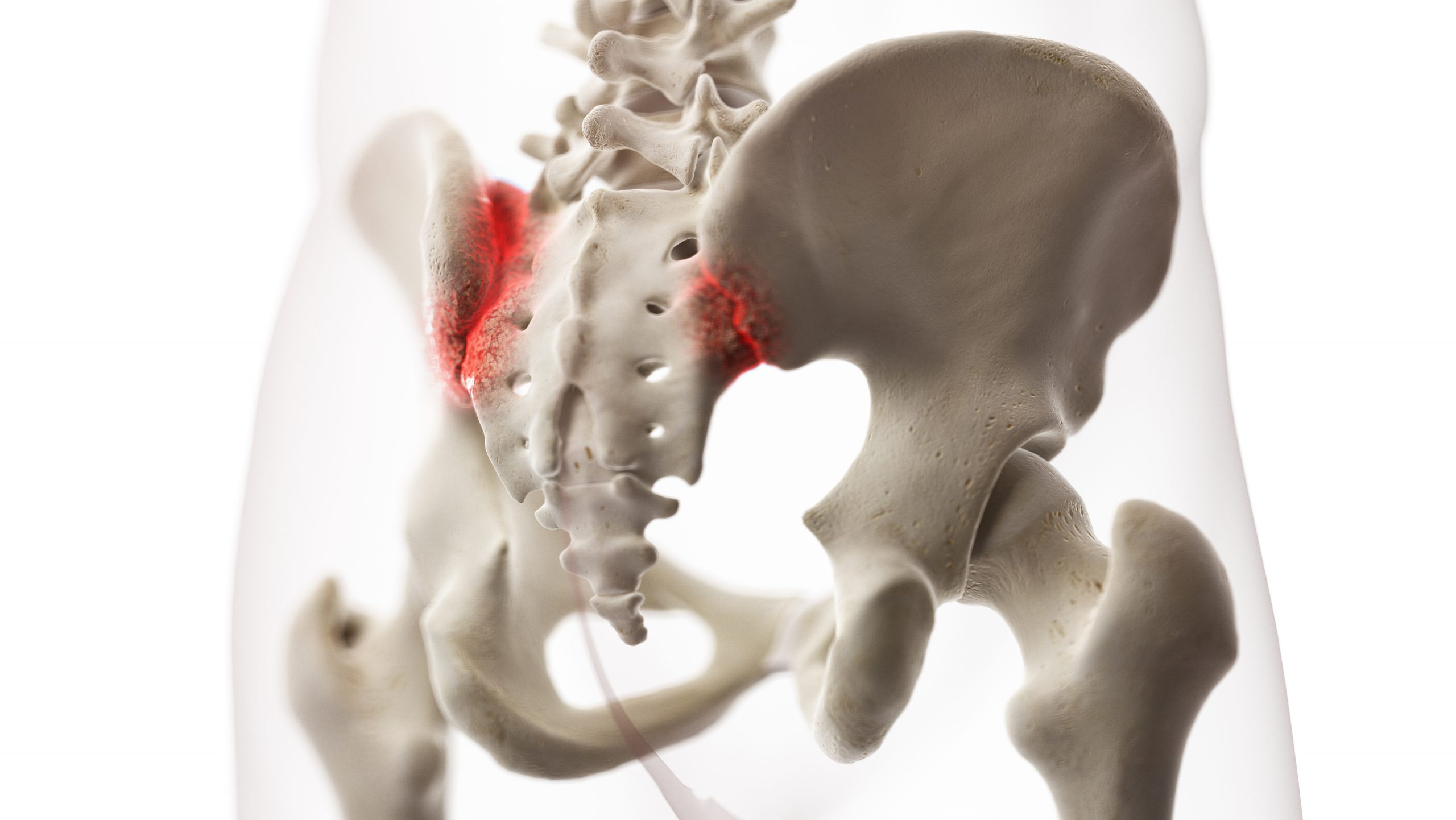 Sacroiliac (SI) Joint Injections To Treat Facet Related Pain Total Spine