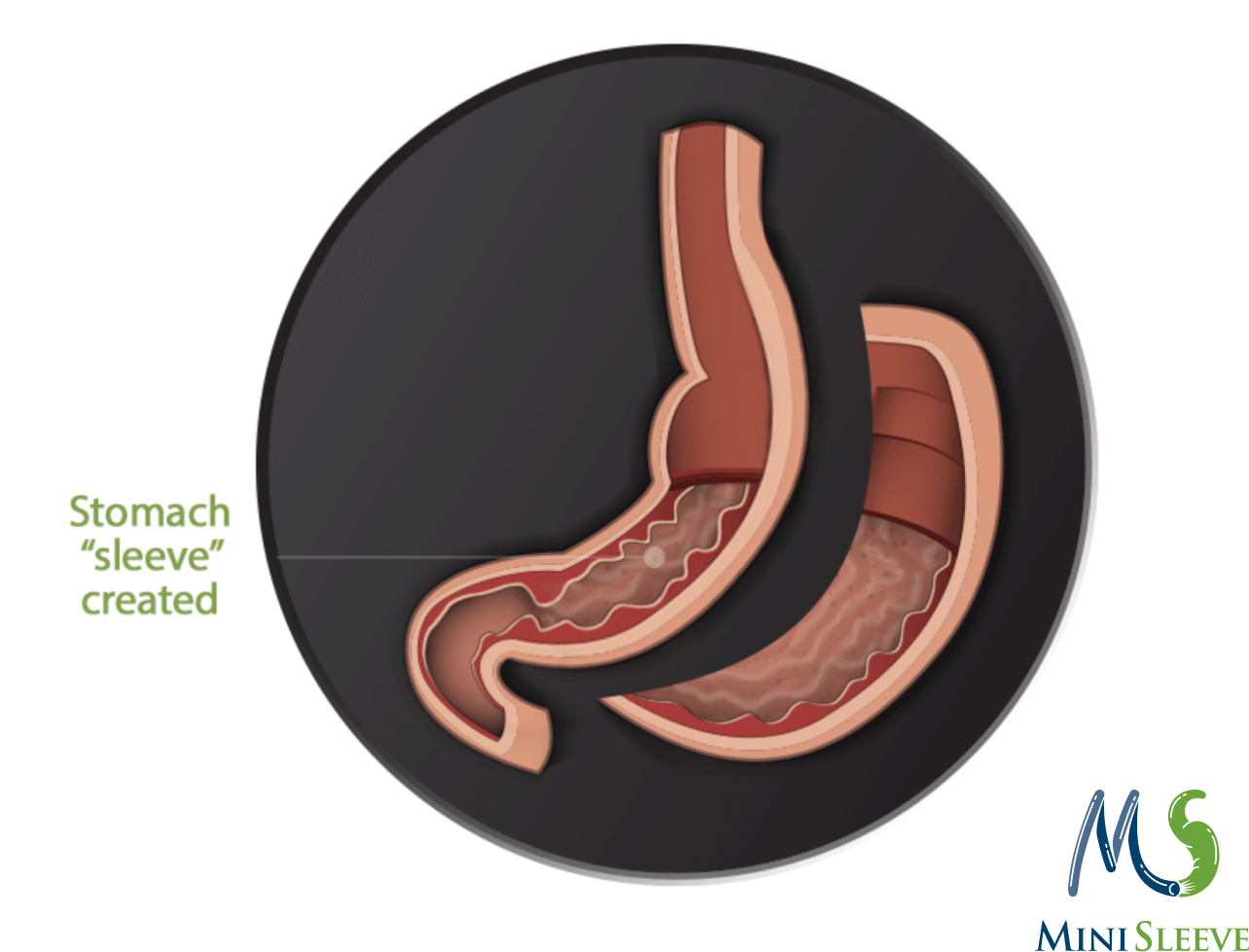 The Mini Sleeve®. Minimally Invasive Mini Gastric Sleeve Surgery