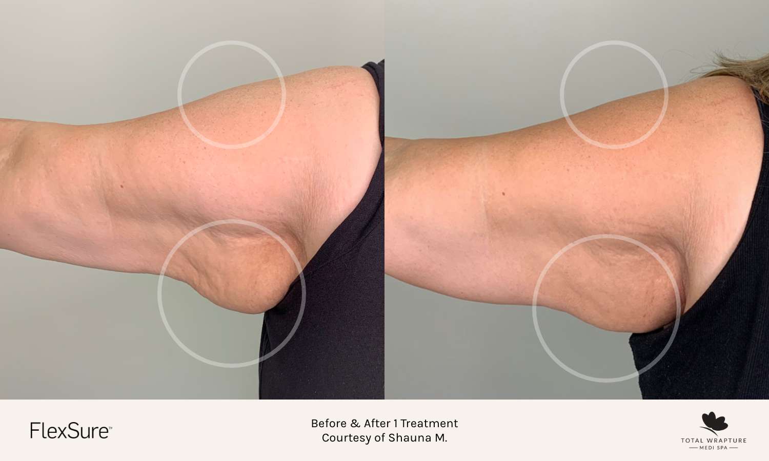 It’s RF Body Contouring Season Spring Into a Confident Summer Total