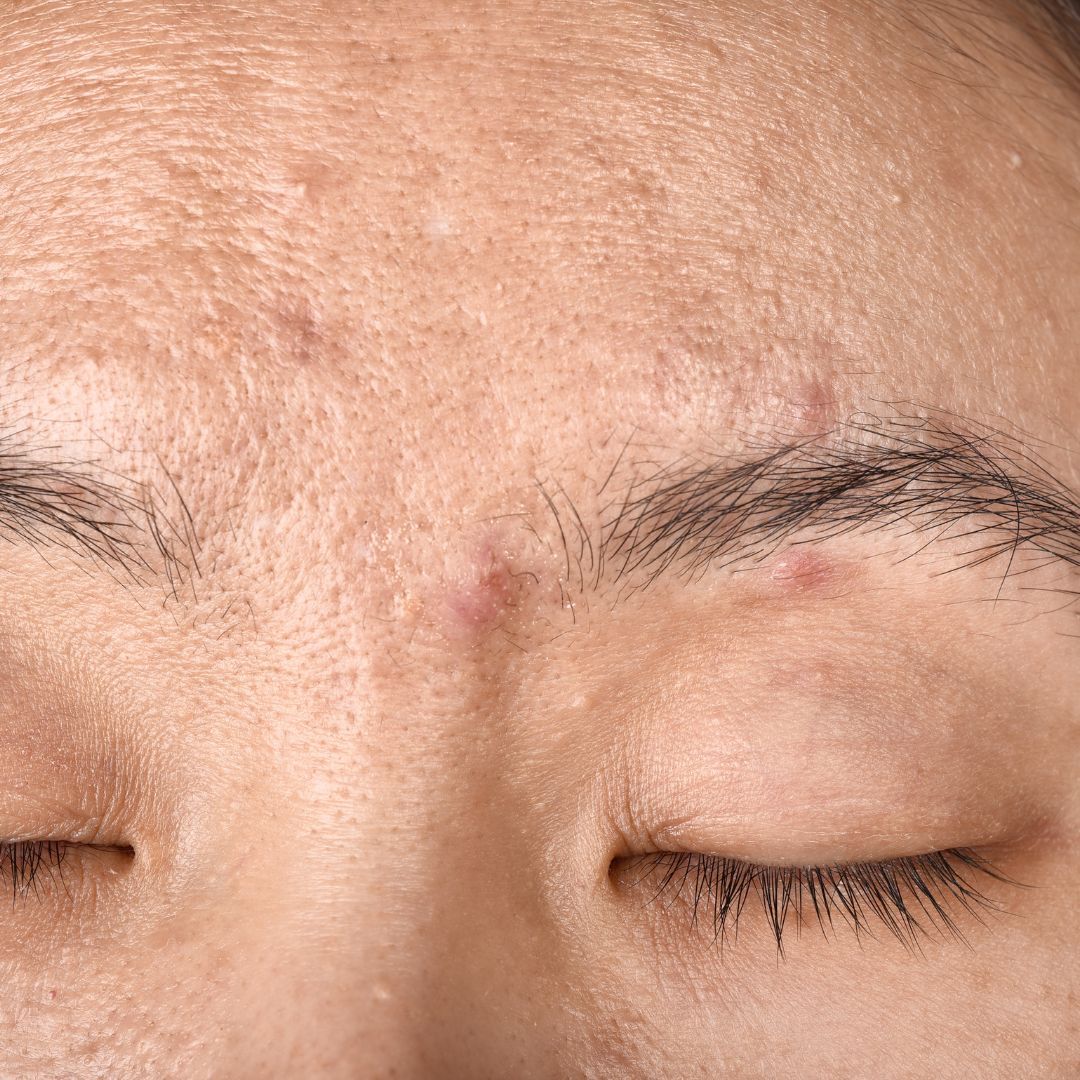 Acne in Your 40s and 50s Treatments & Prevention