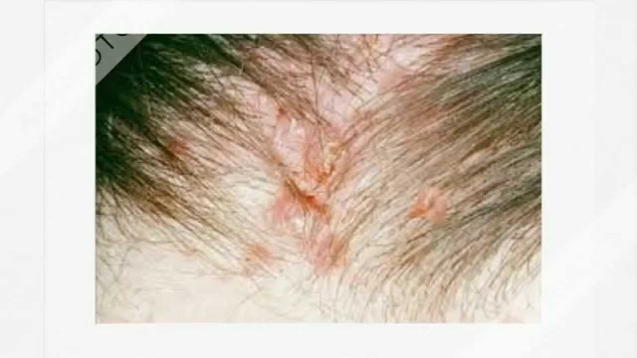 How To Treat Scalp Scabs | Tots Of A Black Girl