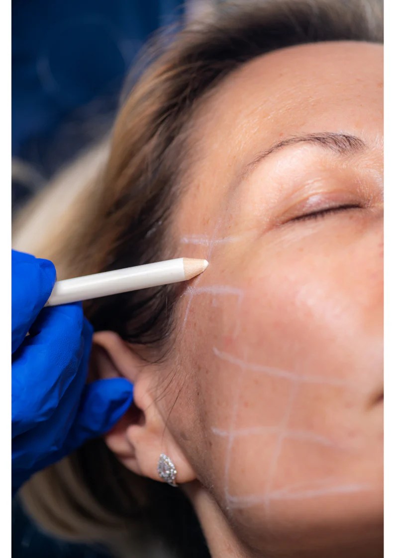 Thread Face Lift Touch laser medical spa