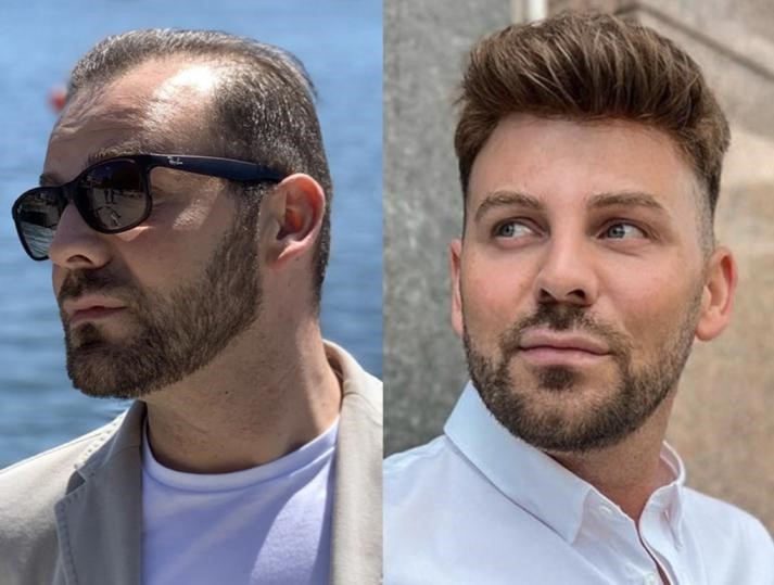 Mastering the Thin Skin Hair System A Complete Guide Toupee 101