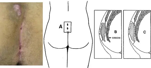 Pilonidal Sinus دکتر تولیت Dr Towliat