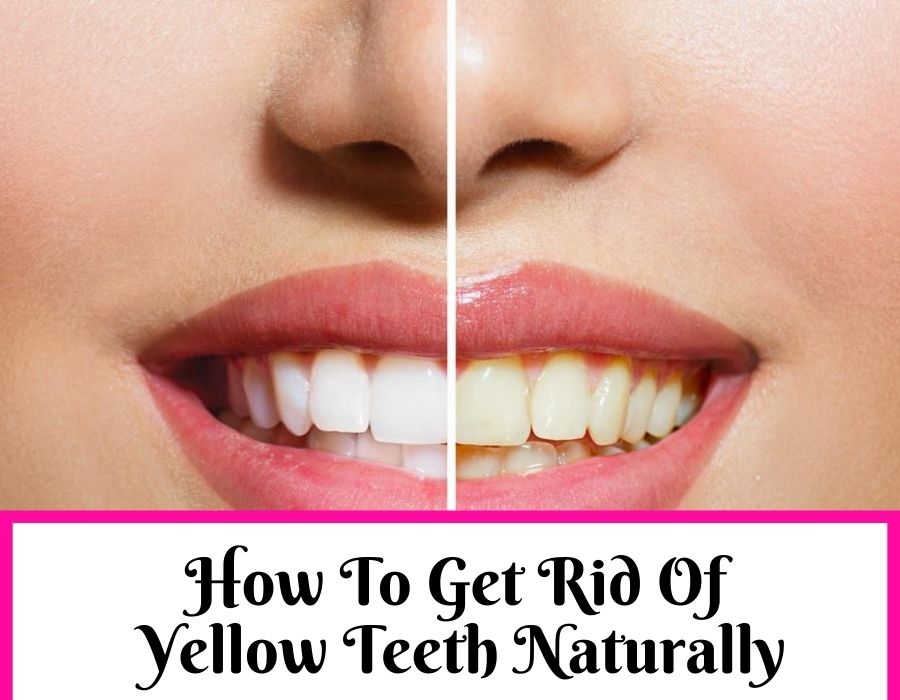 How To Get Rid Of Yellow Teeth Wacote Party