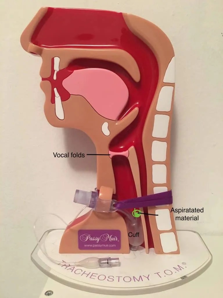 Cuff Deflation Tracheostomy Education