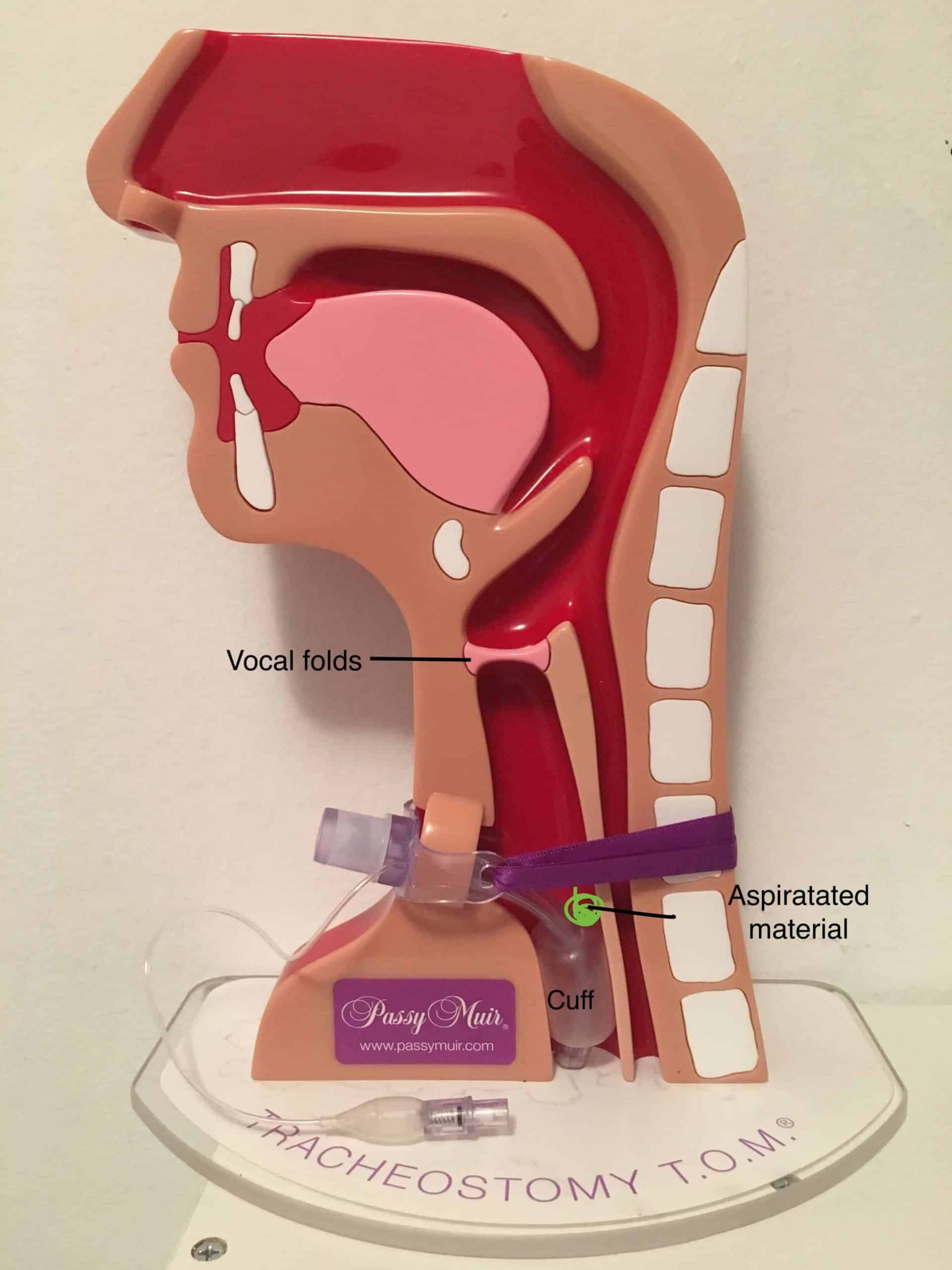 Swallowing Management Of Individuals With Tracheostomy Tracheostomy