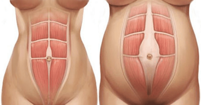 Diastase: Wat Is Het? (En Wat Je Er Aan Kan Doen) - Training For Mamas