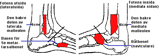 Stukad fot vad du behöver veta när du skadat fotleden