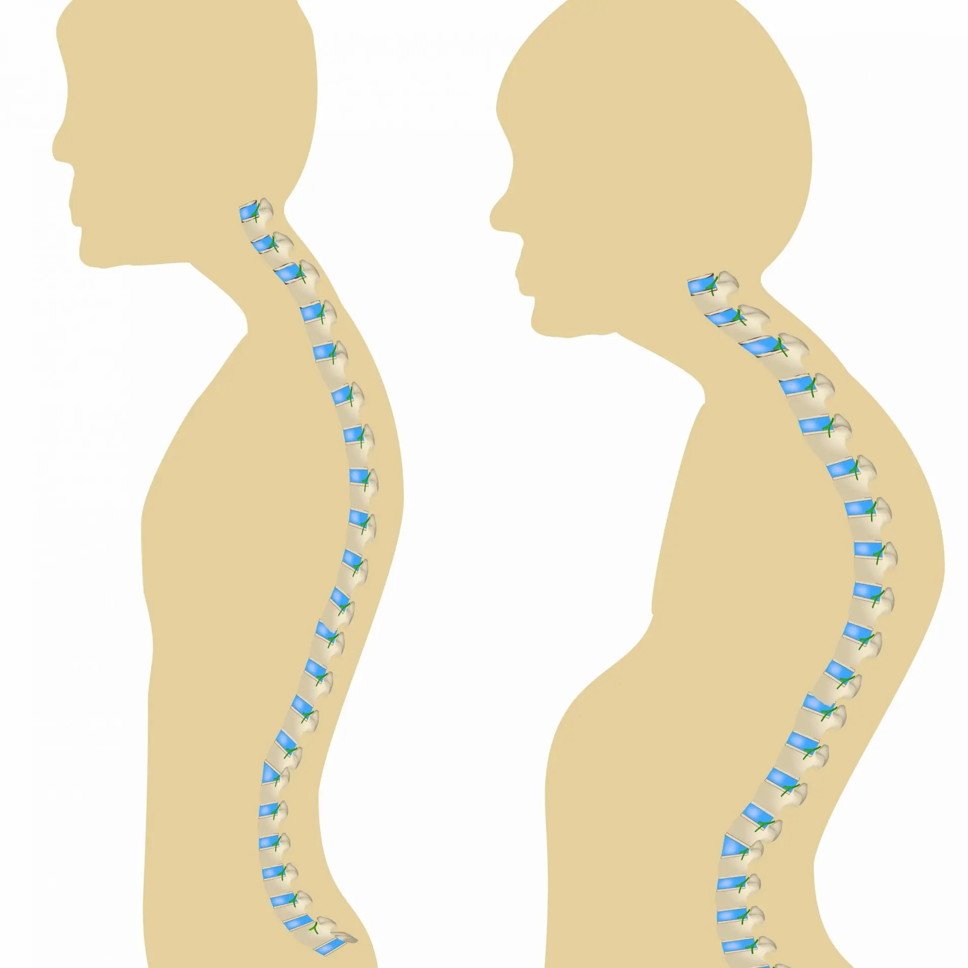 Posture Correction Toronto Transform Chiropractic
