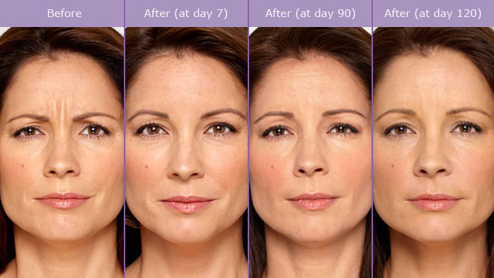 Botox Treatment Before & After Transform Me Med Spa