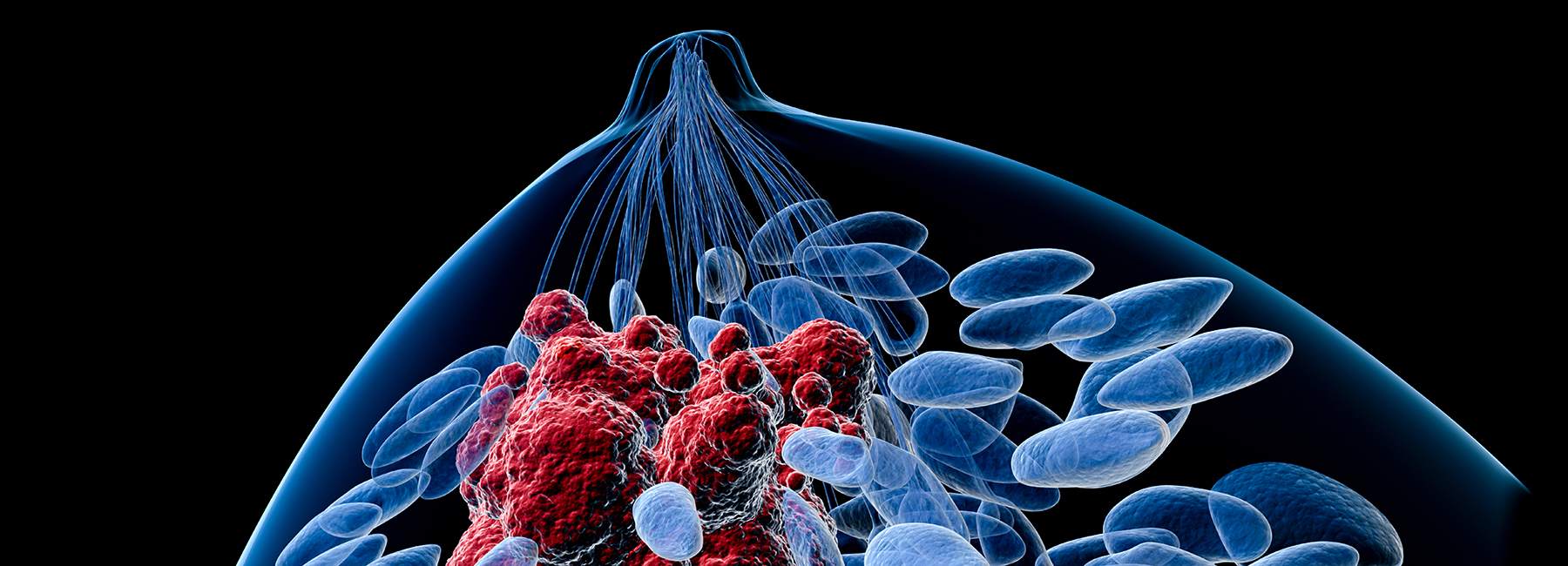 Artificial Intelligence Now Being Used for Breast Cancer Detection