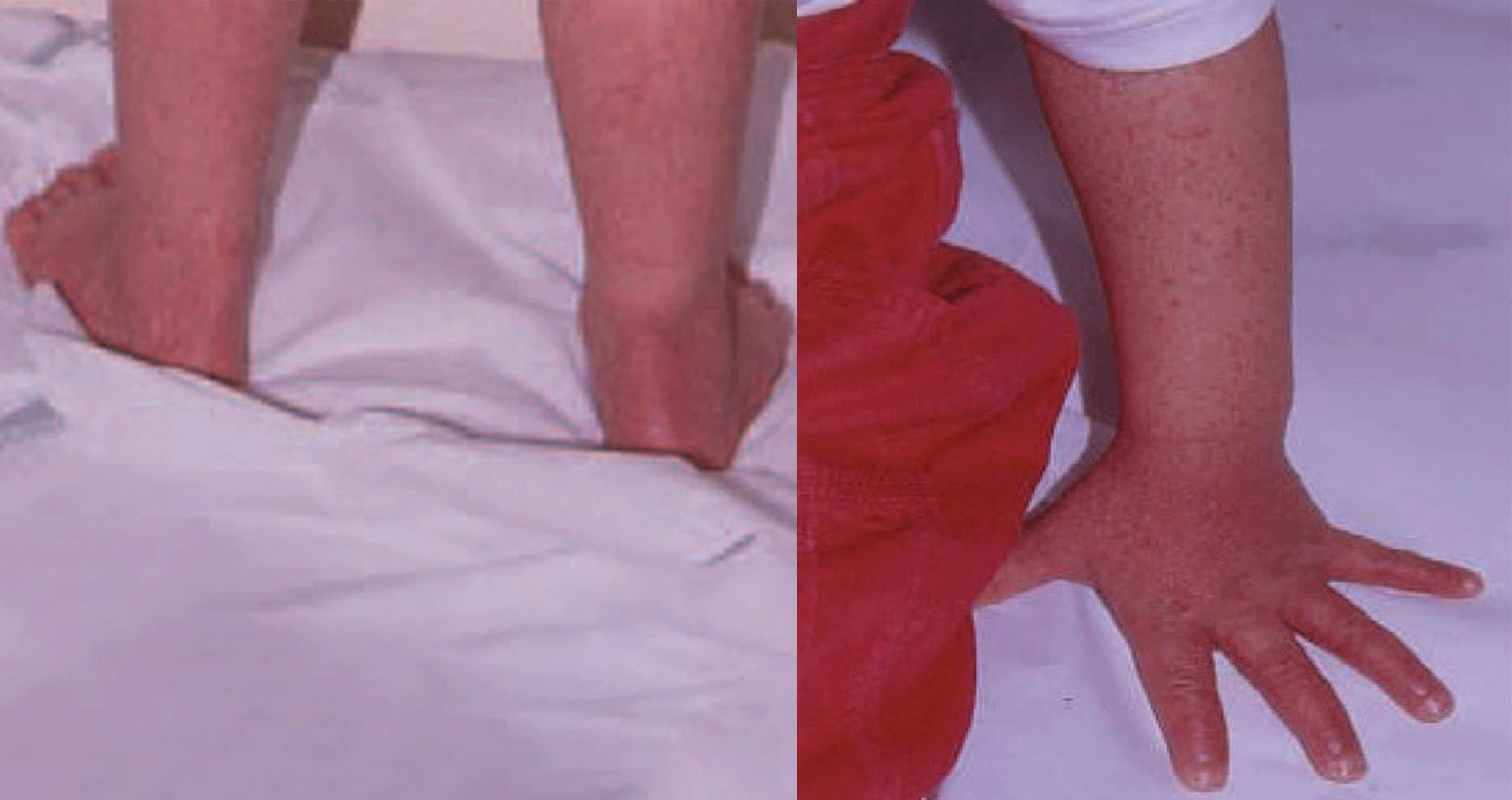 INFECÇÕES POR Parvovírus B19 Tratado de Clínica Pediátrica