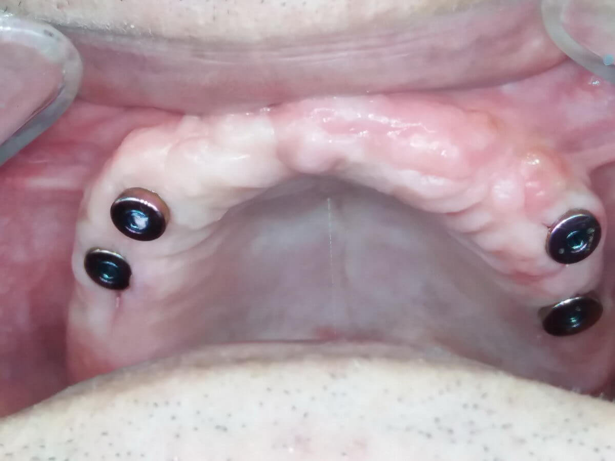 Barretained implant overdenture for treating edentulous maxilla TRATE