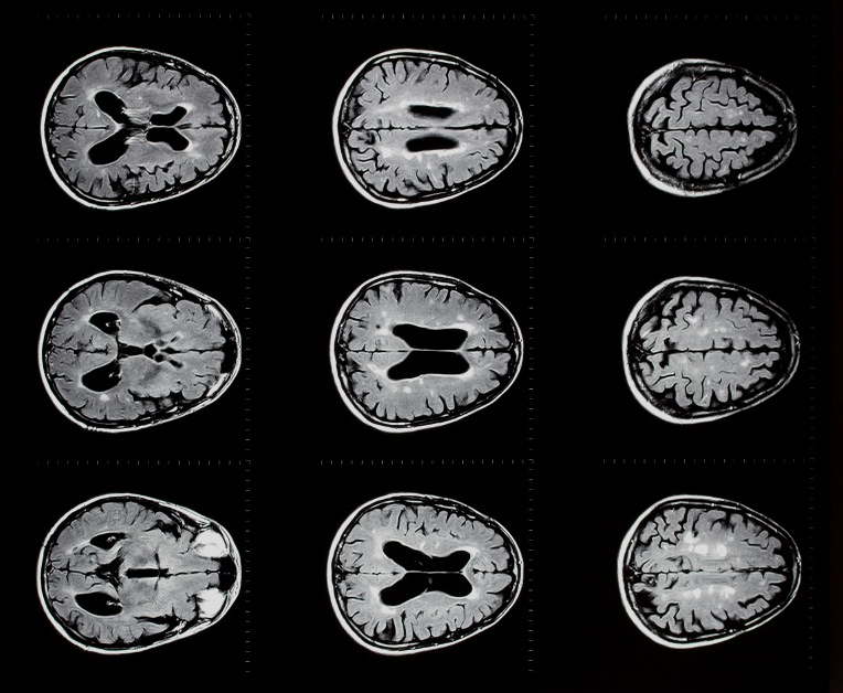 mri ms brain scan | Travis White Communications