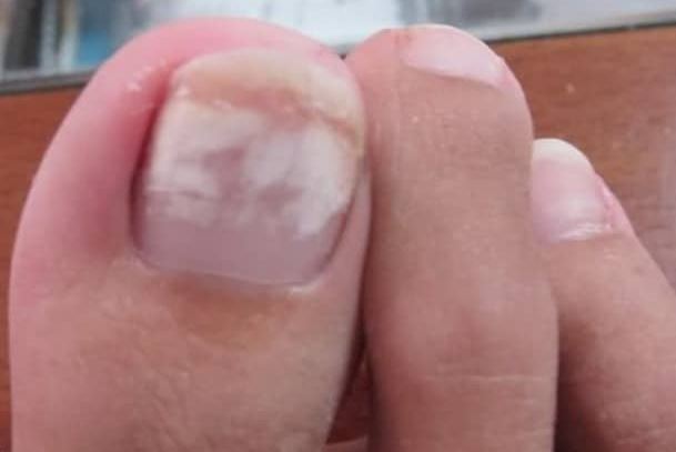 White Spots on Toenails Meaning, Causes, Marks, Pictures, Treatment