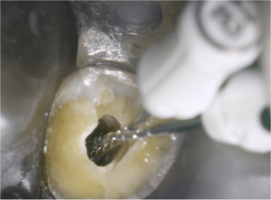 Case Report of a Silver Point Removal TriCity DevTriCity Dev